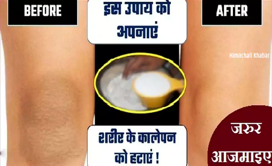 शरीर के काले अंगों को इन चमत्कारी घरेलु नुस्खों को अपनाकर करें चकाचक साफ, कुछ ही दिनों में दिखेगा रिजल्ट शरीर के काले अंगों को इन चमत्कारी घरेलु नुस्खों को अपनाकर करें चकाचक साफ, कुछ ही दिनों में दिखेगा रिजल्ट