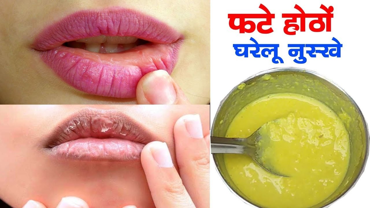 फटे होंठ एक दिन में मुलायम हो जाएंगे, दूध और गुलाब की पत्तियां इस तरह लगाएं फटे होंठ एक दिन में मुलायम हो जाएंगे, दूध और गुलाब की पत्तियां इस तरह लगाएं